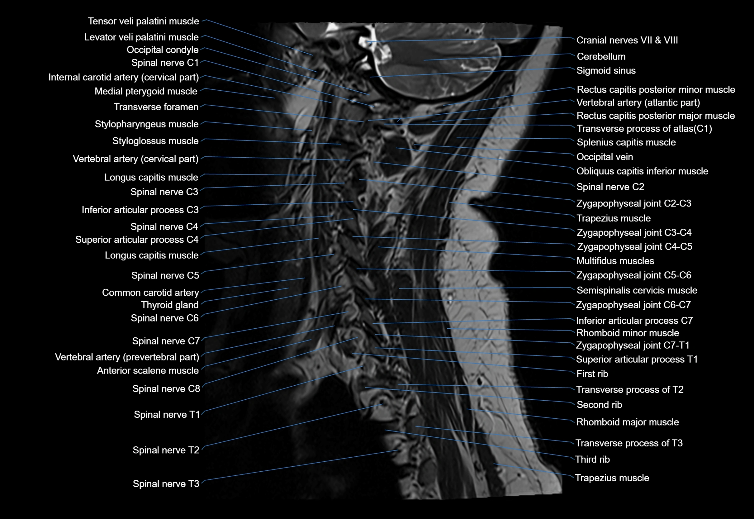 cervical spine cross sectional MRI anatomy 3T MRI  sagittal image-img-00001-00007.webp